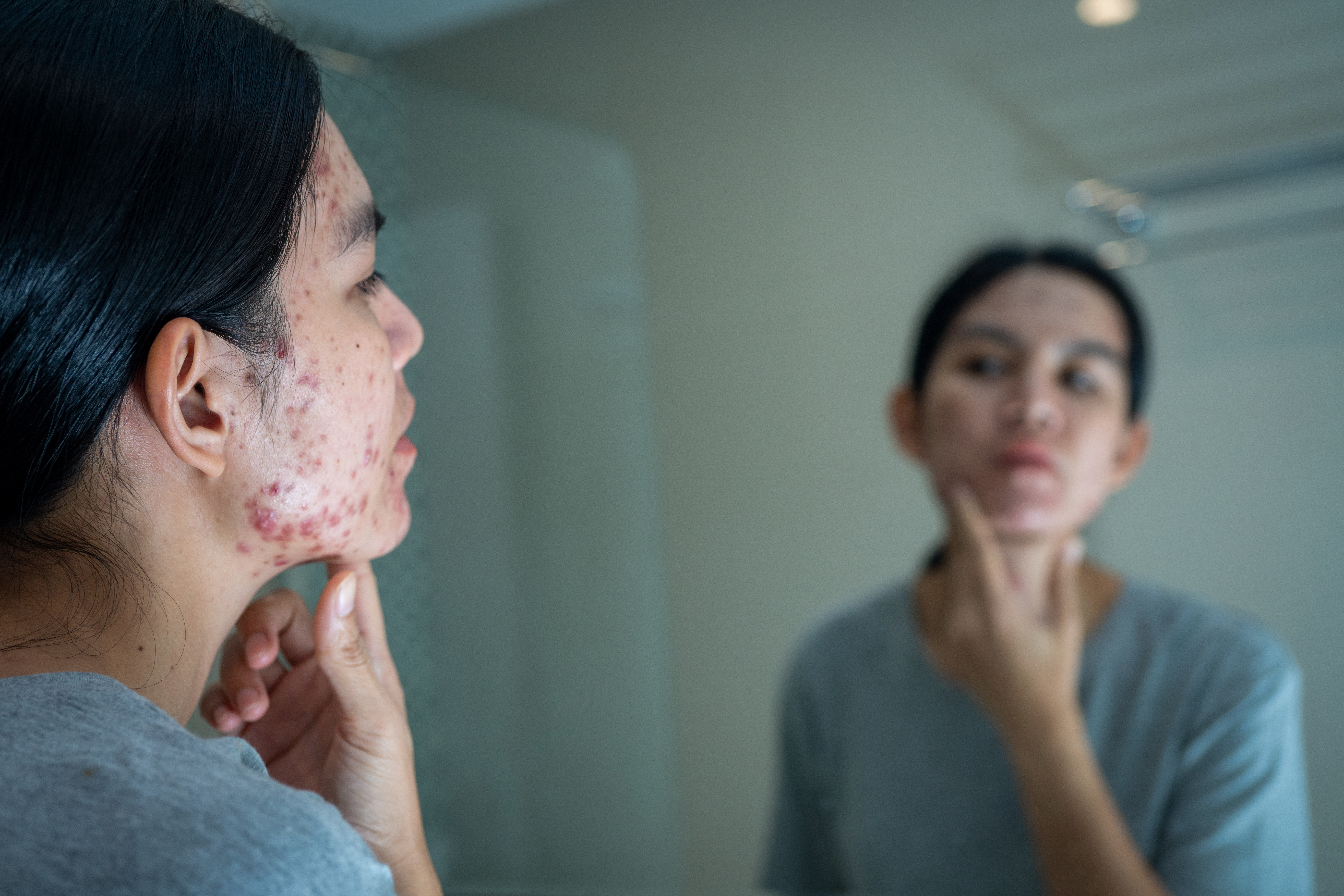 Fatores Hormonais e Acne: Entenda a Relação e Melhores Tratamentos