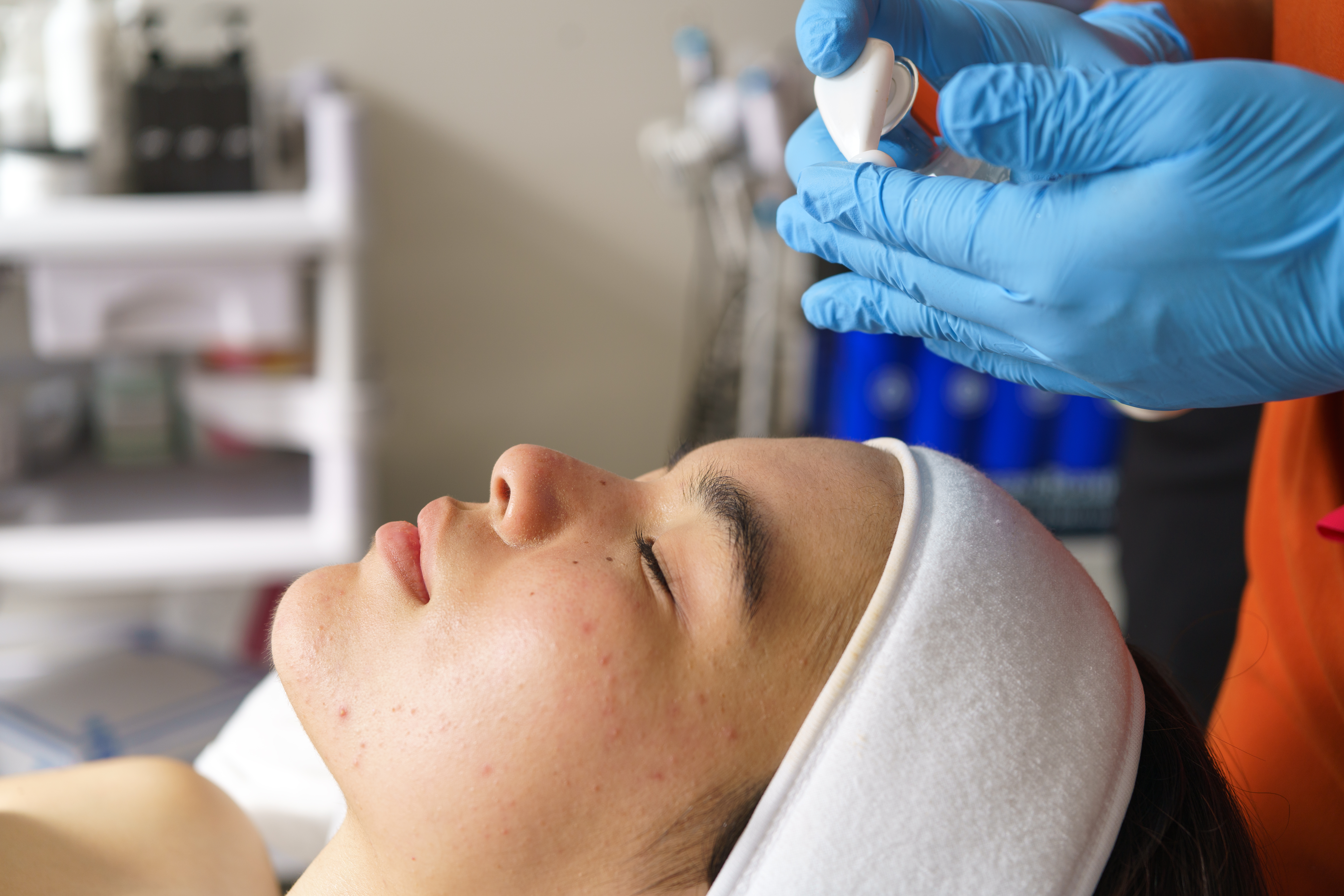 Melasma: Causas, Prevenção e os Tratamentos mais Eficazes