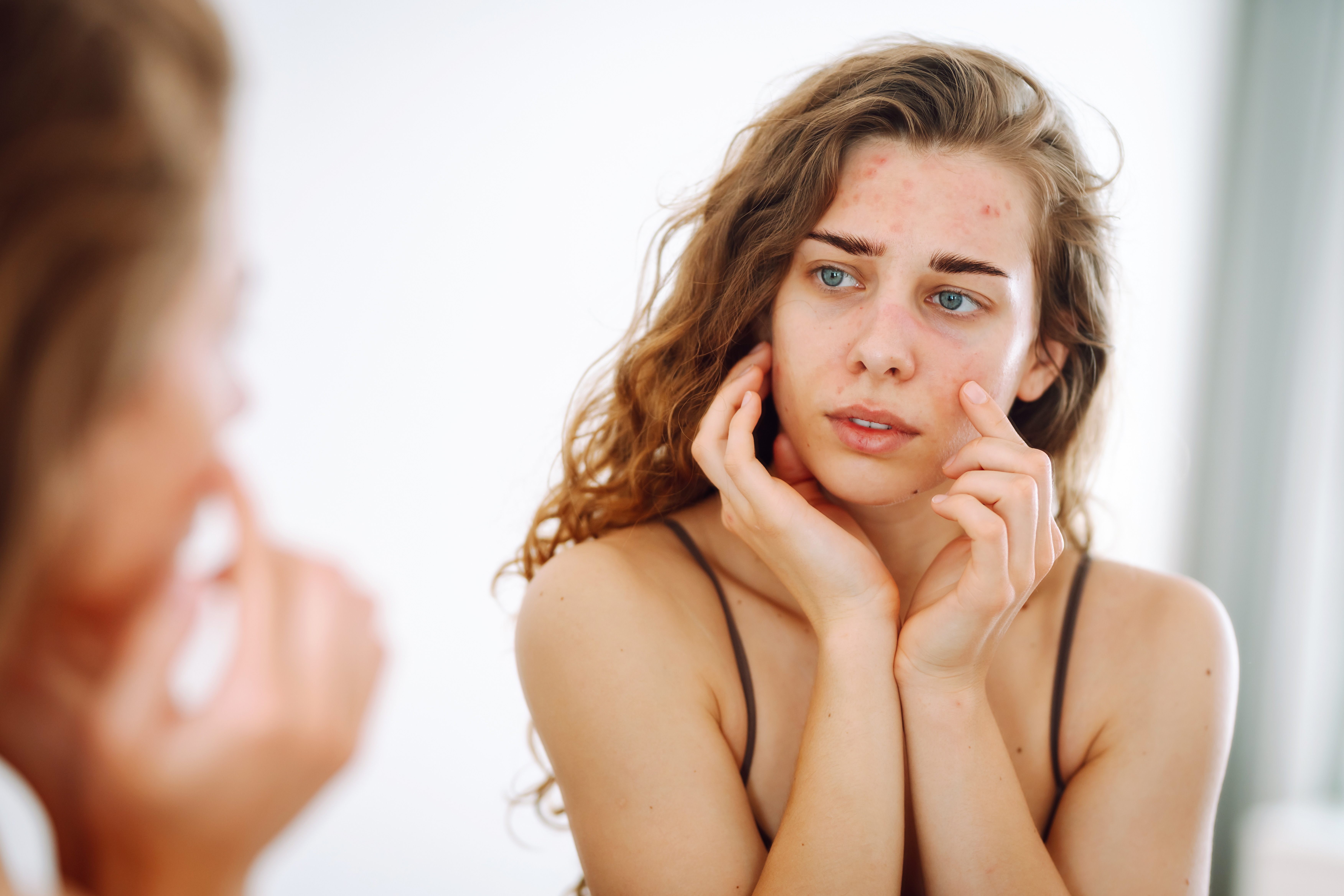 Acne: Como prevenir, Tratar e Cuidar da Pele de Forma Eficaz